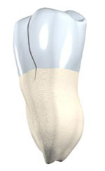 Craze lines in tooth enamel