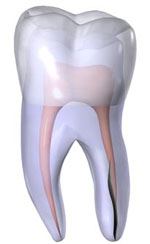Vertical root fracture diagram