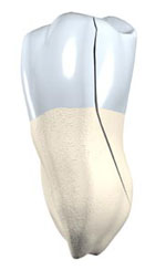 Split tooth diagram