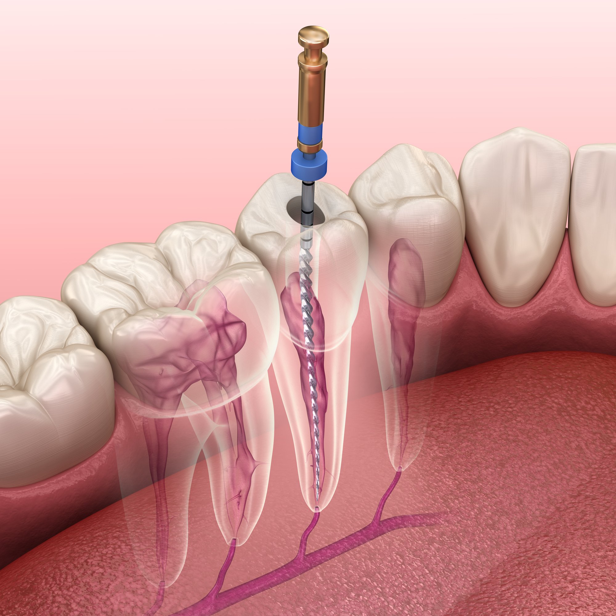 Patient being treated for a returning infection after a root canal