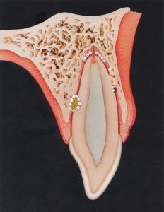 External resorption External resorption