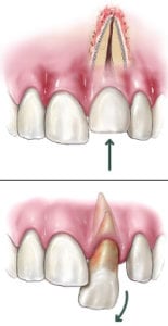 dislodged-tooth dislodged-tooth